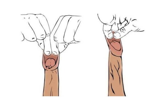 Sử dụng thuốc bôi corticosteroid