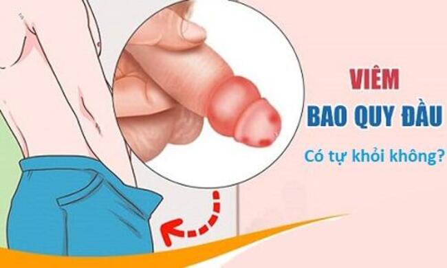 Viêm bao quy đầu có tự khỏi không