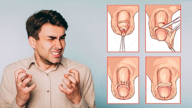 Điều trị hẹp bao quy đầu