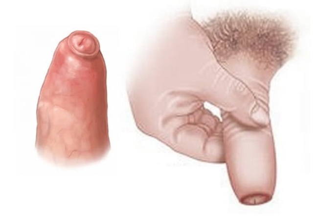 Sử dụng thuốc bôi hẹp bao quy đầu