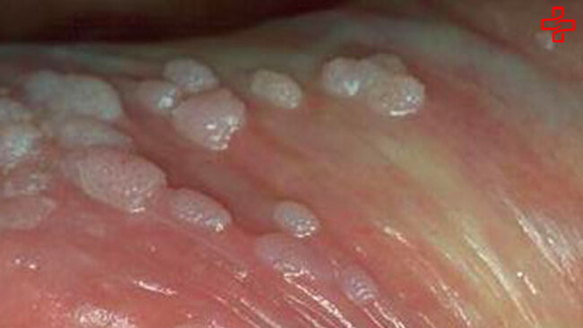 Tình trạng viêm bao quy đầu có mủ không điều trị