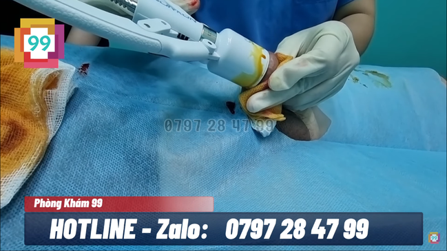 Thực hiện cắt bao quy đầu bằng máy