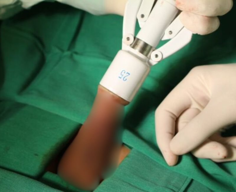 Cắt bao quy đầu là gì