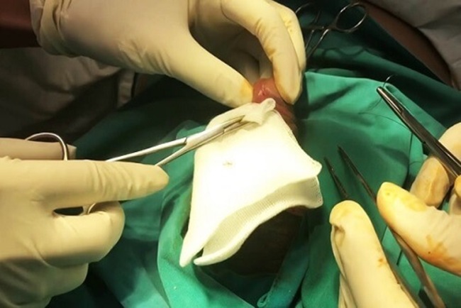 Phẫu thuật kéo dài cậu nhỏ