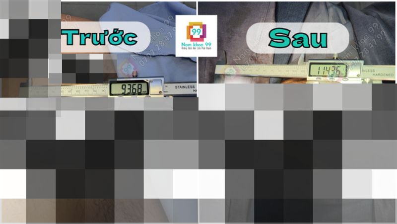 Hình ảnh trước và sau khi kéo dài cậu nhỏ