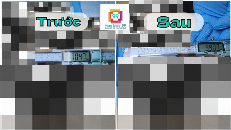 Hình ảnh trước và sau khi phẫu thuật