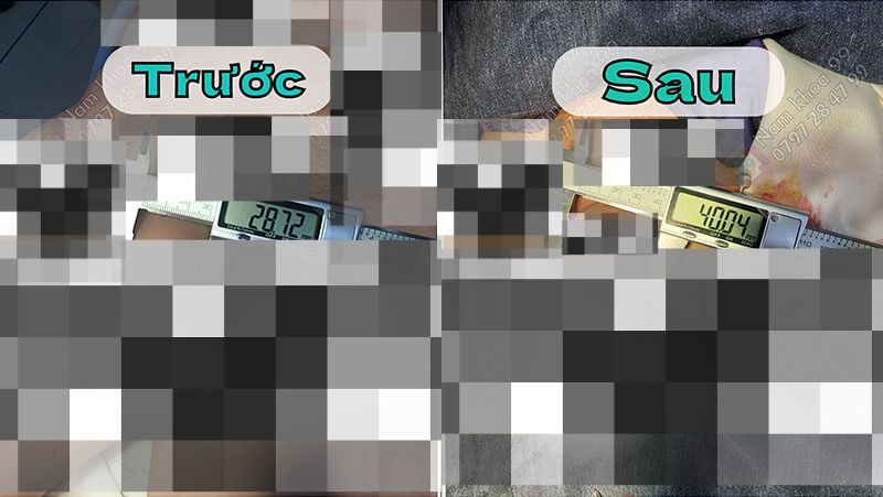 Kết quả phẫu thuật làm to dương vật do trung tâm thẩm mỹ nam giới 99 thực hiện