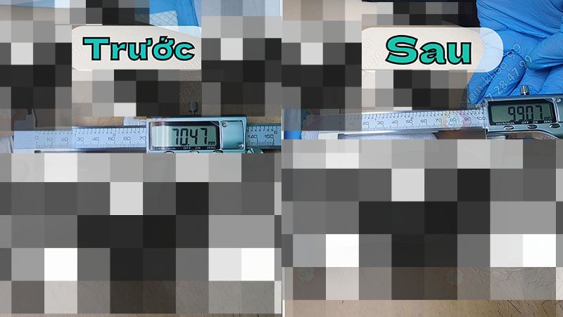 Kết quả phẫu thuật trước và sau khi làm to dương vật