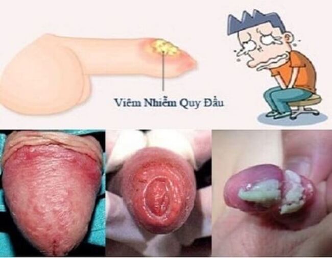 Viêm bao quy đầu có mủ