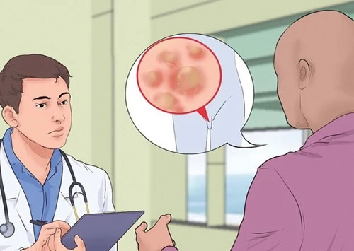 đốt sùi mào gà bao lâu khỏi