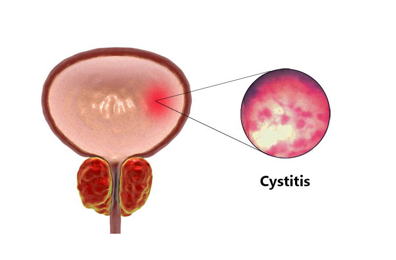 Các triệu chứng viêm bàng quang bạn không thể bỏ qua 2