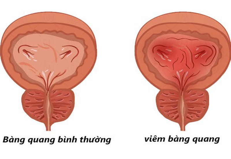 Các triệu chứng viêm bàng quang bạn không thể bỏ qua 3