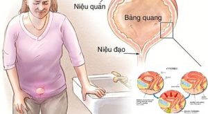 Viêm niệu đạo có thực sự nguy hiểm Những điều cần biết để phòng tránh 1