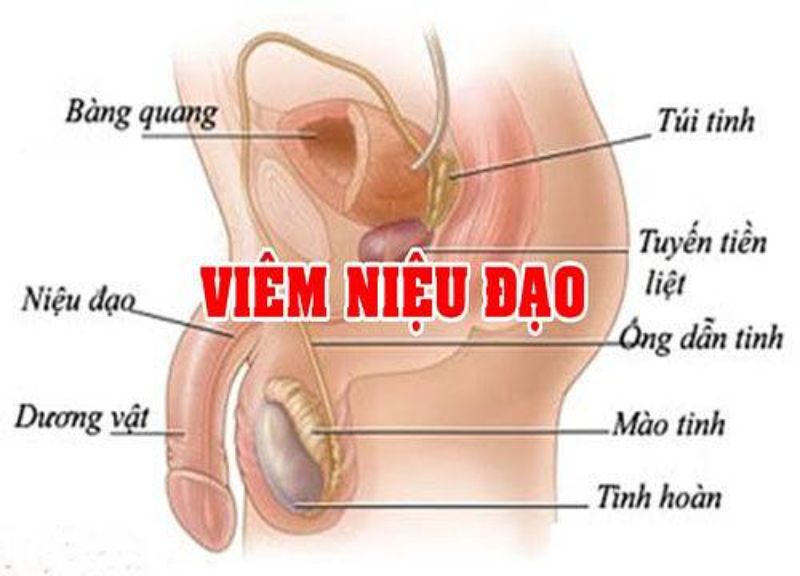 Viêm niệu đạo có thực sự nguy hiểm Những điều cần biết để phòng tránh 3