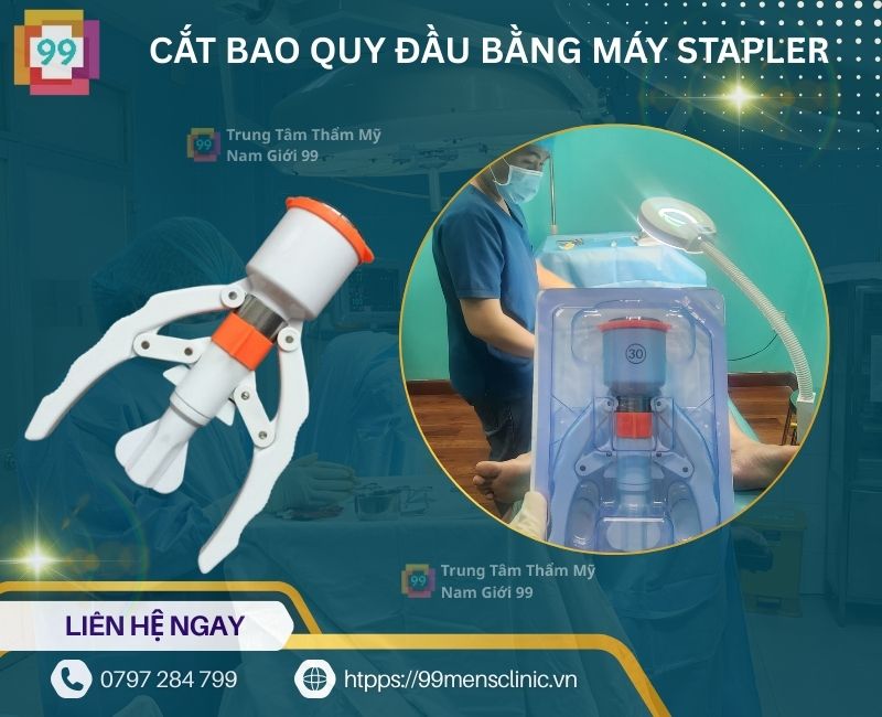 Cắt bao quy đầu bằng máy stapler