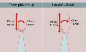 Chi phí phẫu thuật tăng kích thước cậu nhỏ