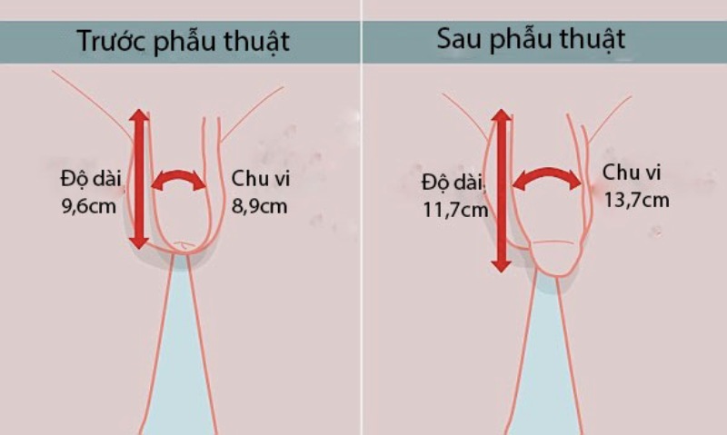 Chi phí phẫu thuật tăng kích thước cậu nhỏ