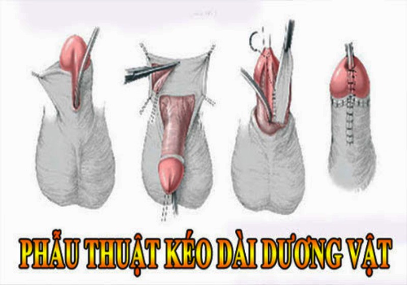 Phẫu thuật tăng kích thước cậu nhỏ giá bao nhiêu còn tùy vào phương pháp thực hiện