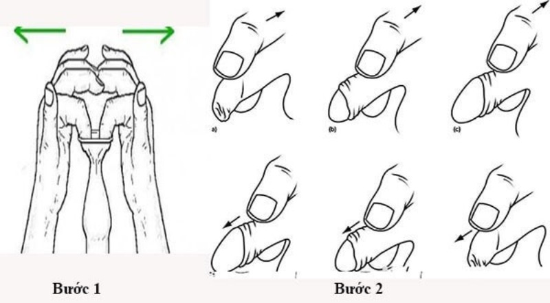 Lột bao quy đầu cho người lớn tại nhà