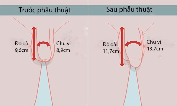 Phẫu thuật tăng kích thước cậu nhỏ