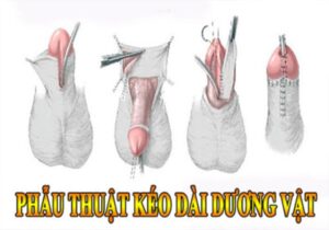 phẫu thuật kéo dài cậu nhỏ TPHCM