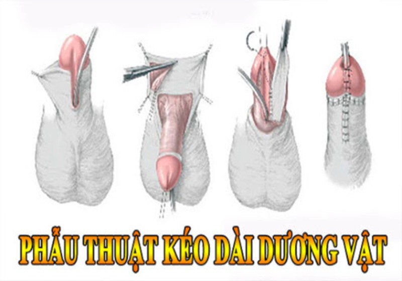 phẫu thuật kéo dài cậu nhỏ TPHCM