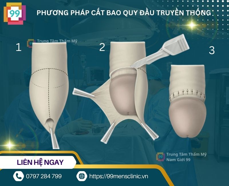 Phương pháp cắt da quy đầu truyền thống