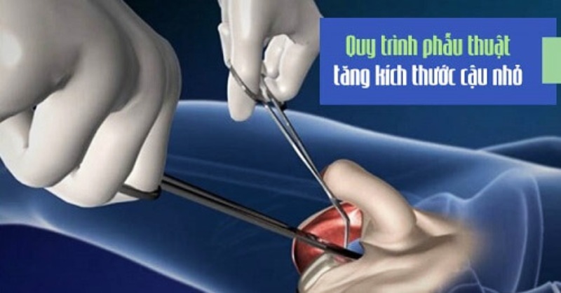 Cắt dây chằng cheo giúp dương vật 