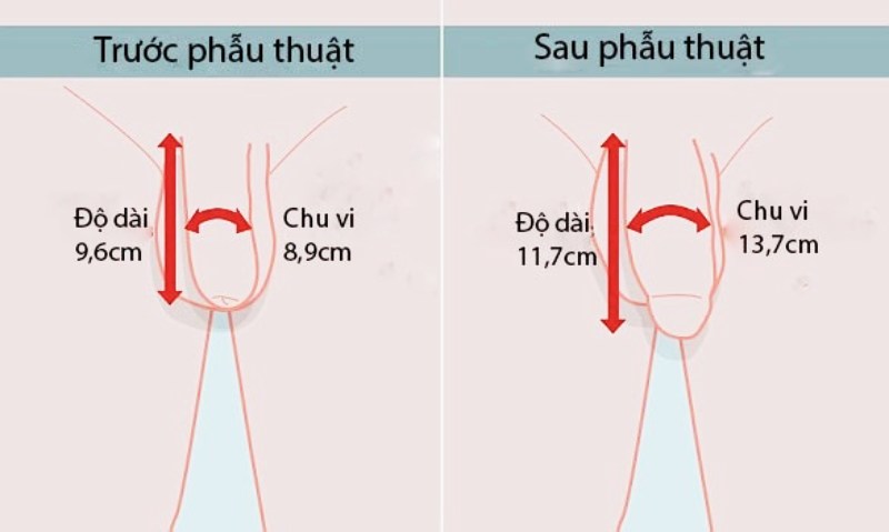 Phẫu thuật tăng kích thước cậu nhỏ