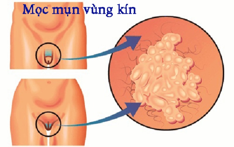 cách trị mụn cậu nhỏ tại nhà