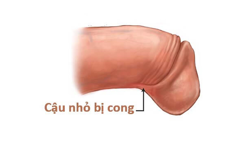Cậu nhỏ bị cong có ảnh hưởng đến sinh sản không?