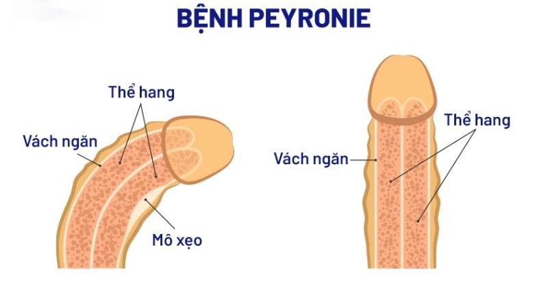 cậu nhỏ cong sang trái có sao không