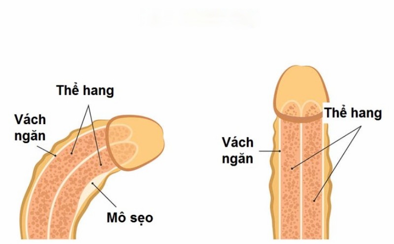 cậu nhỏ cong xuống có sao không