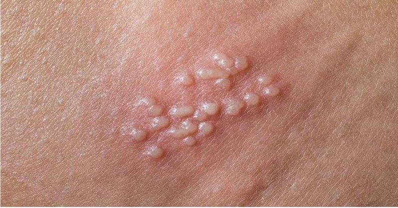 cậu nhỏ nổi mụn trắng không ngứa