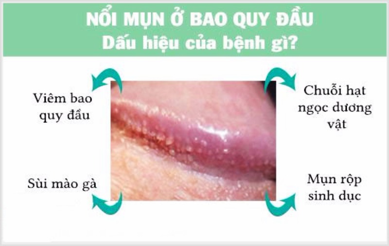 cậu nhỏ nổi mụn trắng không ngứa