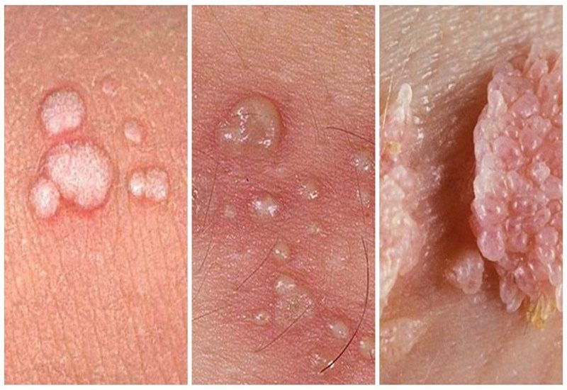 cậu nhỏ nổi mụn trắng không ngứa