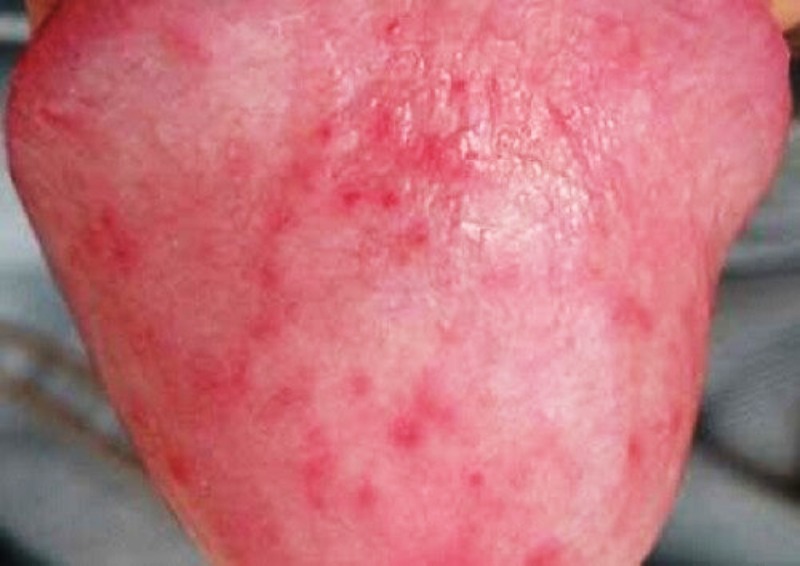 cậu nhỏ nổi mụn trắng không ngứa