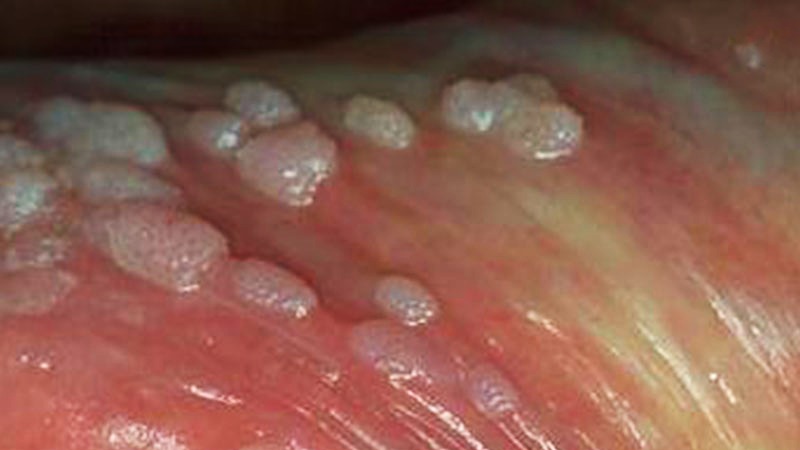 cậu nhỏ nổi mụn trắng không ngứa