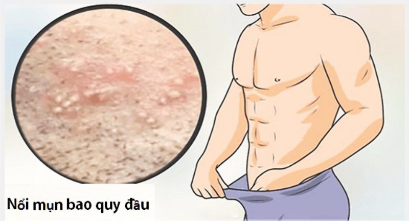 cậu nhỏ nổi mụn trắng không ngứa