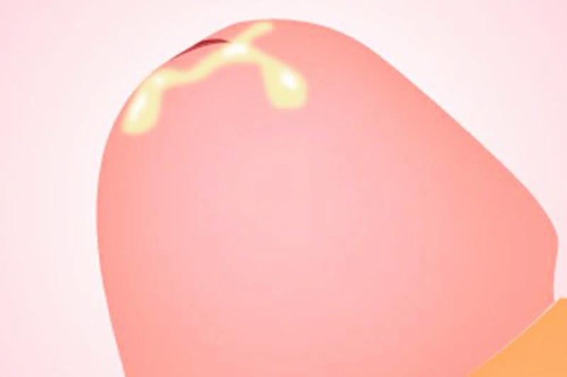 cậu nhỏ ra dịch trắng có nguy hiểm không