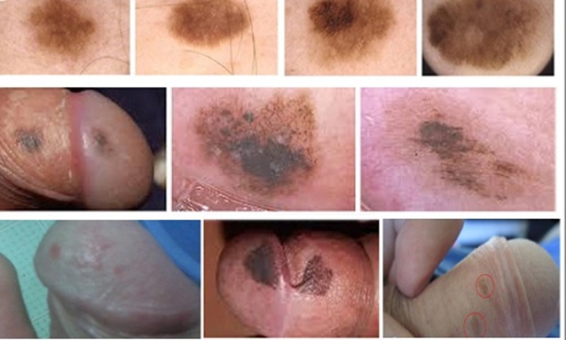 cậu nhỏ xuất hiện đốm đen