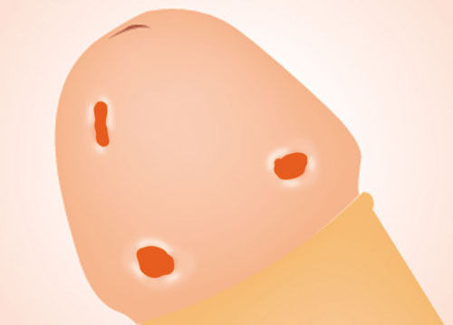 Dương vật nổi mụn