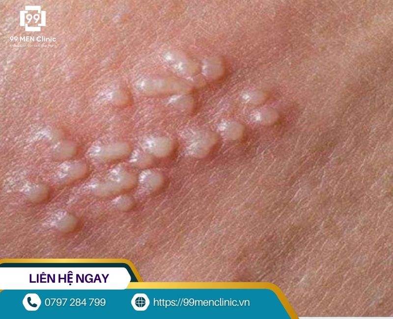 Hạt bã nhờn sinh dục gây ra mụn trắng