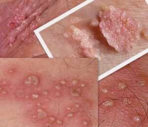 mụn li ti ở cậu nhỏ