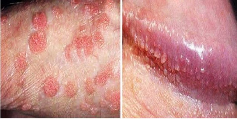 mụn li ti ở cậu nhỏ