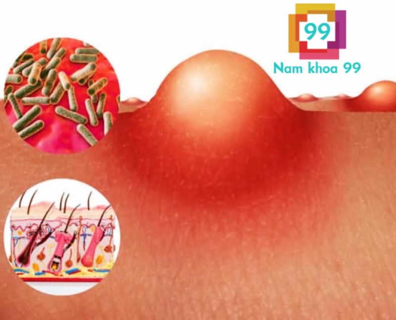 mụn li ti ở cậu nhỏ