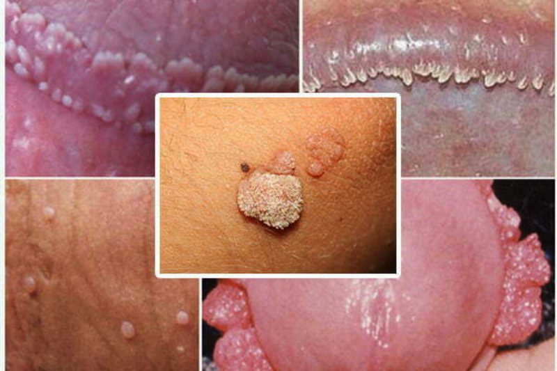 mụn li ti ở cậu nhỏ