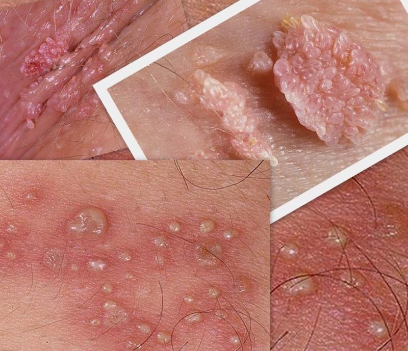 mụn li ti ở cậu nhỏ