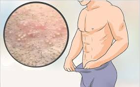 Nổi mụn ở thân cậu nhỏ có nguy hiểm không?