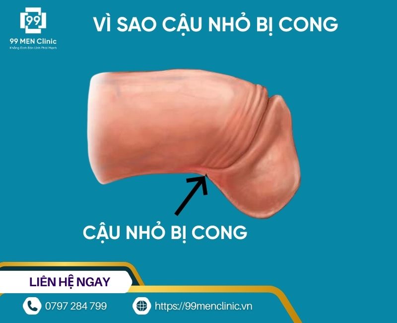 Dương vật cong có ảnh hưởng đến sinh sản không